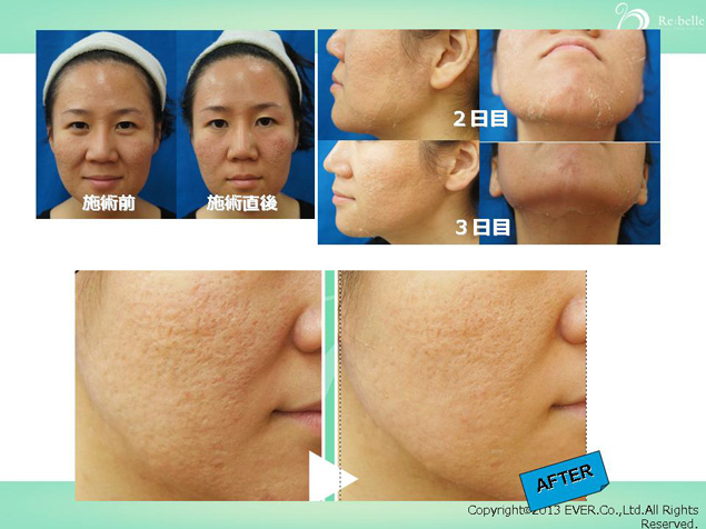 Re：belle～リベルハーブピーリング～